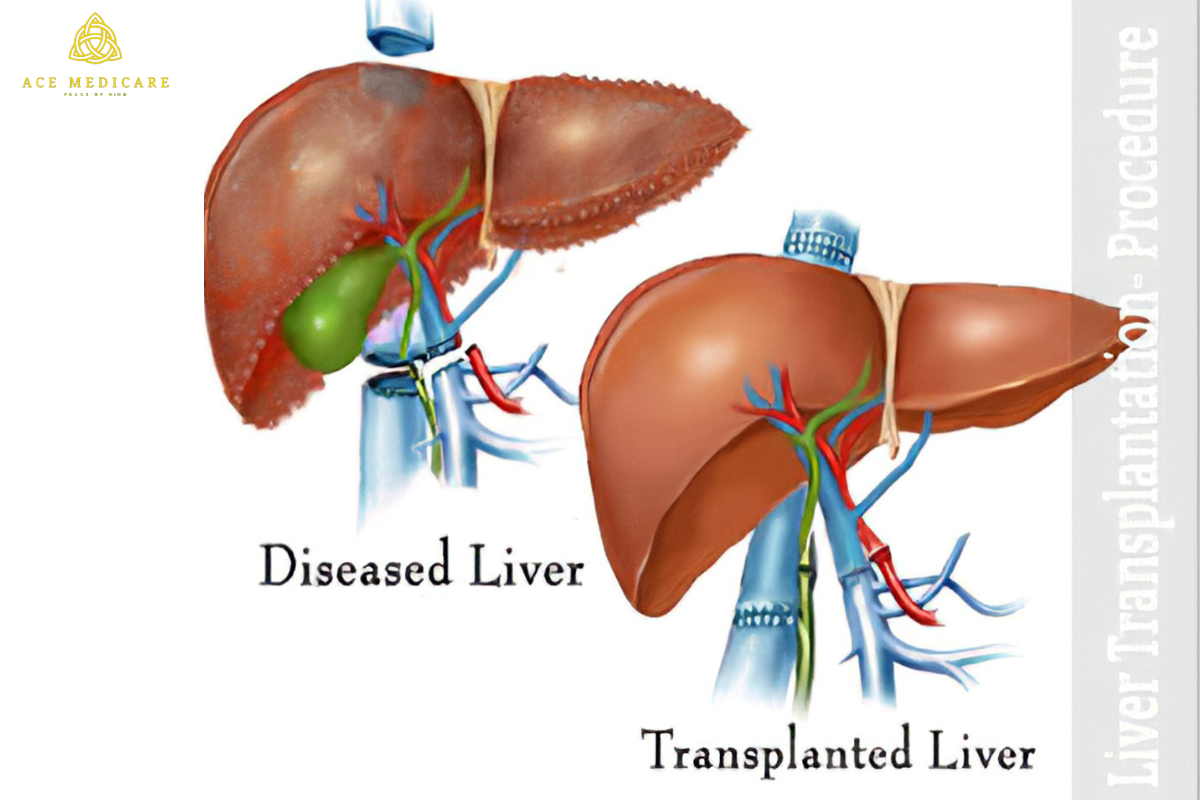 From Hope to Healing: Understanding the Process of Liver Transplantation